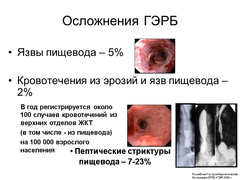 Осложнения ГЭРБ Язвы пищевода – 5%  Кровотечения из эрозий и язв пищевода –